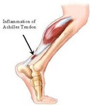 Physical Therapy for Achilles Tendonitis p01