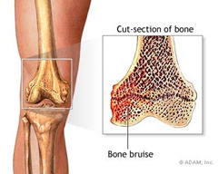 Best Physical Therapist NYC for Bone Bruises 01 Best Physical Therapist NYC for Bone Bruises 01