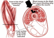 Best Physical Therapist NYC for Bone Bruises 03