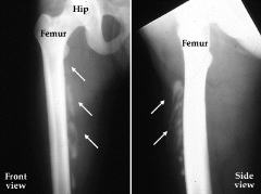 Best Physical Therapist NYC for Bone Bruises 04