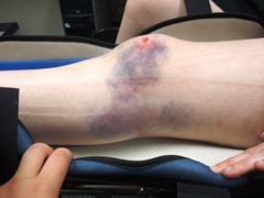 Best Physical Therapist NYC for Bone Contusion 02