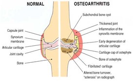 Best Physical Therapist NYC for Knee Osteoarthtiris 01