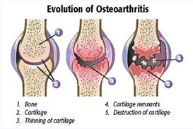 Best Physical Therapist NYC for Knee Osteoarthtiris 02