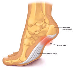 Best Physical Therapist NYC for Plantar Fasiciitis Heel Pain 01