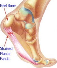 Best Physical Therapist NYC for Plantar Fasiciitis Heel Pain 02