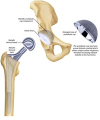 Best Physical Therapist NYC for Total Hip Replacement 02