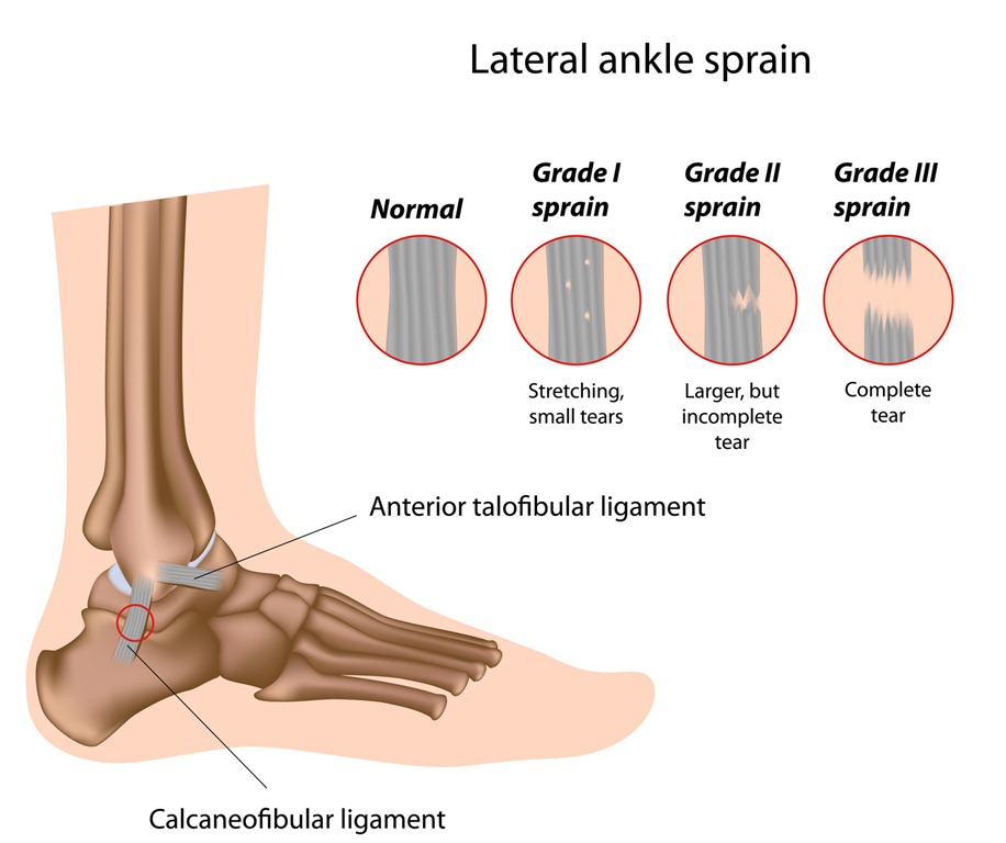 An Ankle Sprain Could Require Physical Therapy - Best Physical