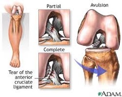 Best Physical Therapist for ACL injury 02