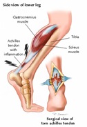 Physical Therapy For Achilles Tendon Pain NYC P04.jpg