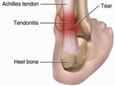 Physical Therapy For Achilles Tendon Pain NYC P05.jpg