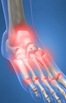 Physical Therapy for Foot Pain PO1