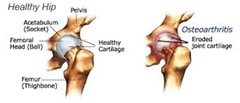 Physical Therapy for Hip Pain NYC1