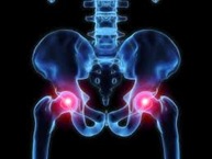 Physical Therapy for Hip Pain PO5