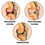 Physical Therapy for Knee Pain NYC 5