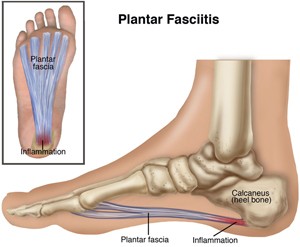 Foot Pain 