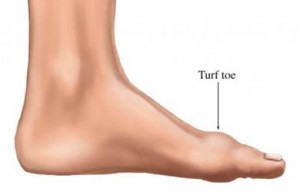 Turf Toe