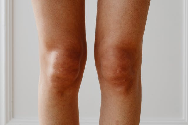 Osteoarthritis in the Knees